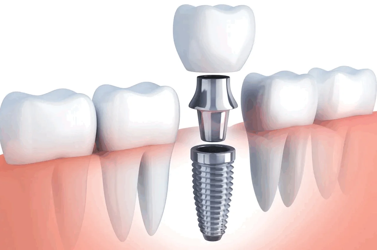 Zubni implantati